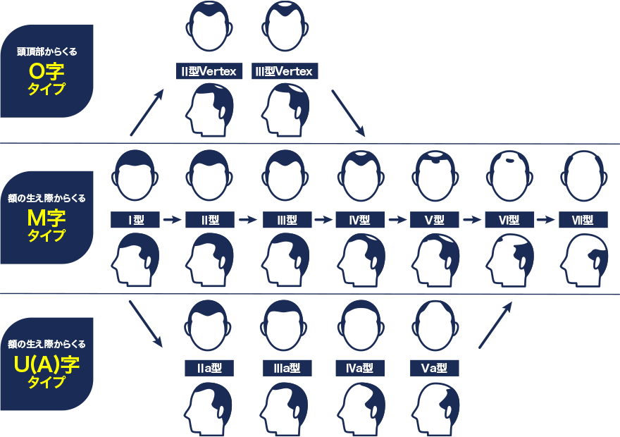 AGAの脱毛パターン