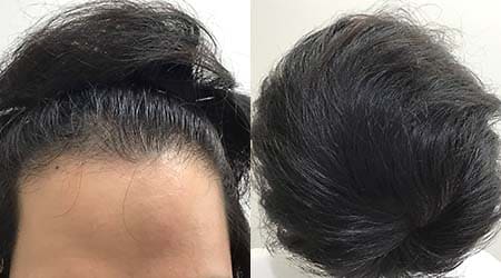 症例2：アフター