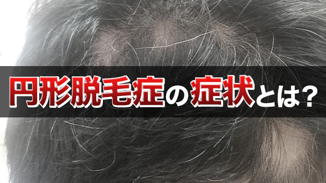 円形脱毛症の症状とは？