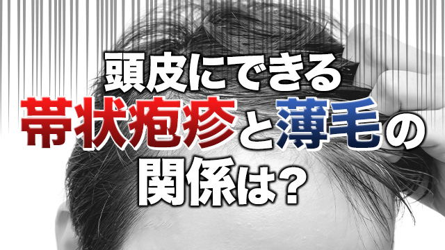 頭皮にできる帯状疱疹と薄毛の関係は？