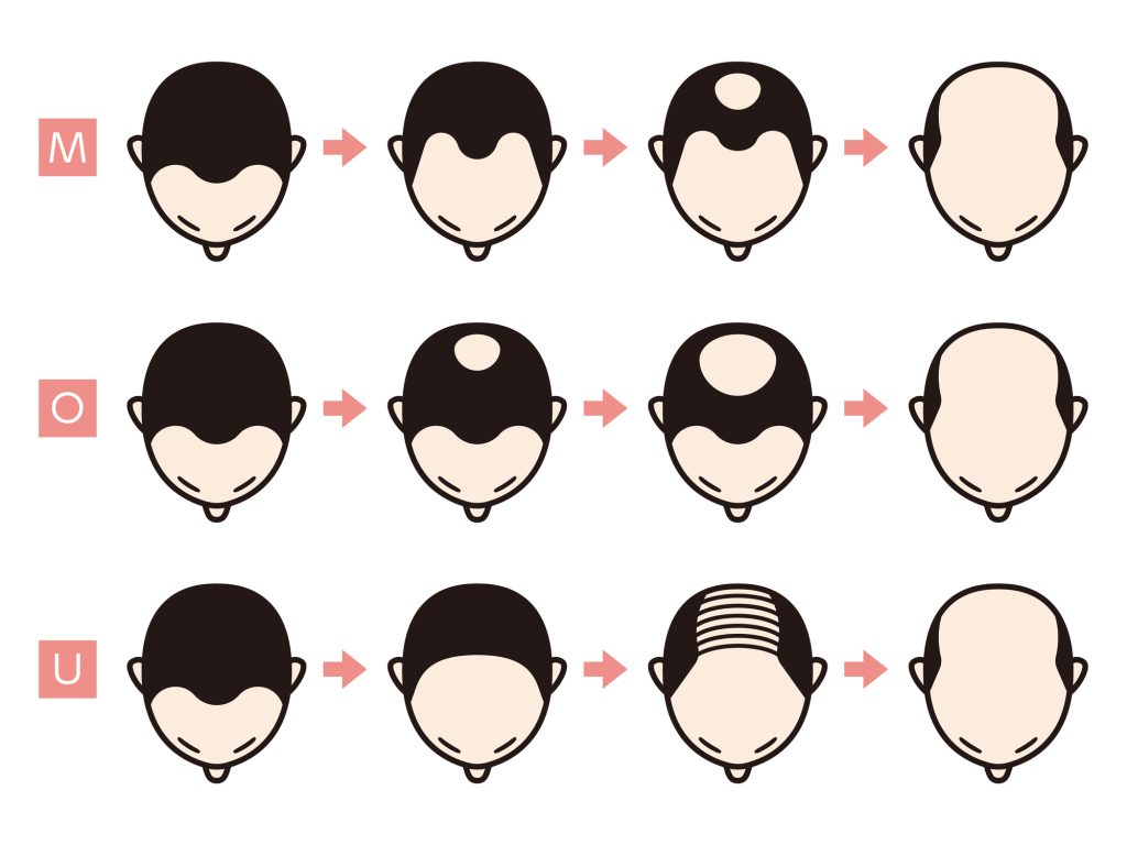 AGA（男性型脱毛症）の特徴